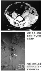 自发性腹膜后出血或血肿