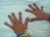 紫绀-杵状指-肝病综合征