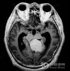 枕骨大孔脑膜瘤