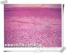 纵隔非霍奇金恶性淋巴肿瘤
