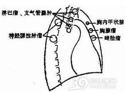 纵隔脓肿