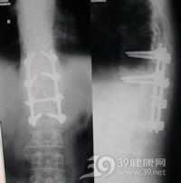 椎弓结核