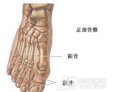 跖骨疲劳性骨折