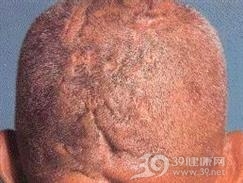 枕骨下硬结性毛囊炎