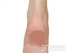 足跟瘀斑