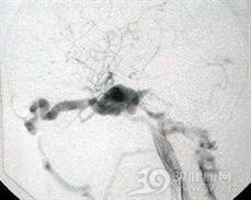 直接型颈动脉海绵窦瘘