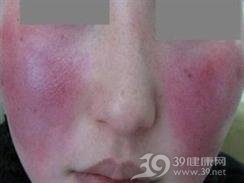 自身免疫性孕酮性皮炎