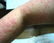 自体敏感性湿疹