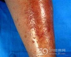 脂性渐进性坏死