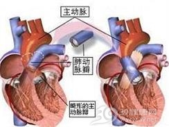 左心室恶性施万瘤