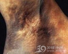 职业黑变病