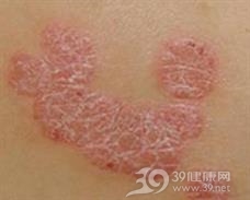 职业性皮肤癌