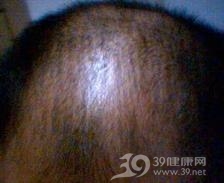 脂溢性脱发