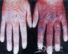 职业性硬皮病