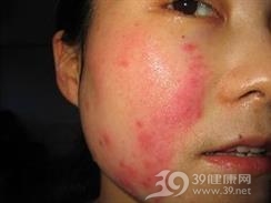 制药业引起的皮肤病