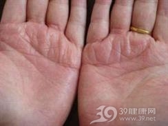 掌跖脓疱病