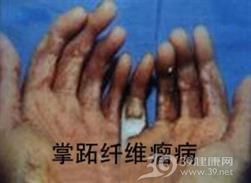 掌跖纤维瘤病